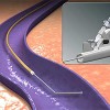 varicose vein surgery